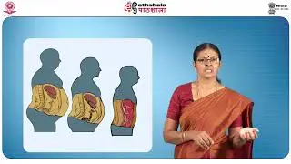 Complications in obesity
