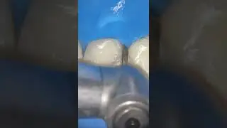 Easy Excess Composite Removal with Intensiv Swingle