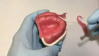 3d) Adapting Maxillary Light Cure Baseplate