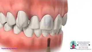 Bonding Brackets