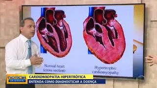 Cardiomiopatia hipertrófica: doença que dificulta o bombeamento do sangue