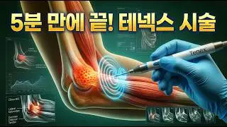 치유되지 않는 테니스엘보, 최신 Tenex 시술로 통증 해결!