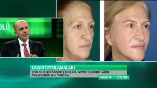 Kılcal damar lekeleri ve doğum lekeleri lazerle tedavi edilebilir mi?