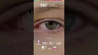 Ocular Redness in Ophthalmic Emergencies ❘ TECH Global University