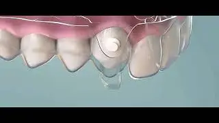 Canine extrusion with Aligners