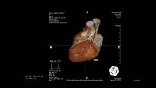 4-Cardiac CT Cases - Dr Ahmed Shehata