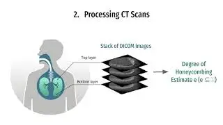 Predicting Lung Function Decline due to Pulmonary Fibrosis (Team 3244 2010 0039)