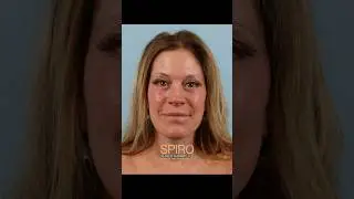 Spiro Plastic Surgery Face and Neck Lift Before and After Transformation