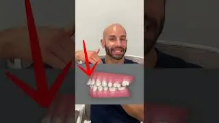 Overbite Correction with Invisalign: Our Smile Design Plan