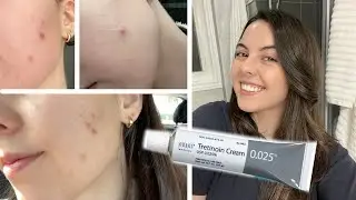 HOW I CLEARED MY SKIN IN 1 MONTH | Tretinoin Cream 0.025% Before and After
