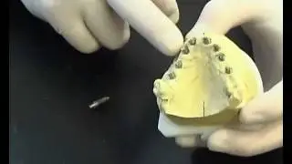 Implantologie: Pose d'un bridge scell&eacute; sur monobloc