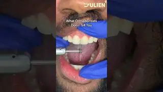 Why Your Dentist May Need To SHAVE Your Teeth Down! 😳🦷