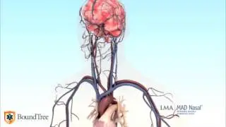 LMA MAD Nasal&trade; Overview