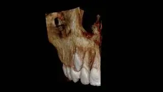 IMPACTED CANINE #CBCT #3dimaging