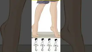 Equinus Gait