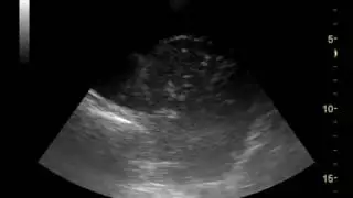 Fluidothorax, alveolar consolidation with static air bronchogram, pleural puncion