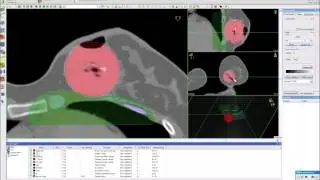 Contura Patient B - Using Oncentra to Treatment Plan a Challenging Case
