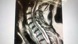 Retrolisthesis at C3-4