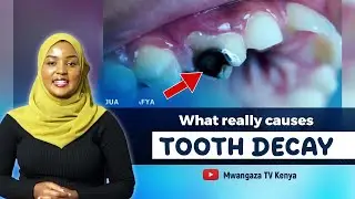 Dentist explains: The Causes, Symptoms and Prevention of Tooth Cavity