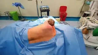 rhabdomyo sarcoma. shoulder. cancer. tumor. latissmus dorsi flap