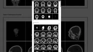 CT brain 🧠🥺 #medical #funny #radiology #anatomy #طب #اكسبلور #baby #تشخيص