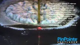 The PinPointe FootLaser Ablates Trichophyton Rubrum