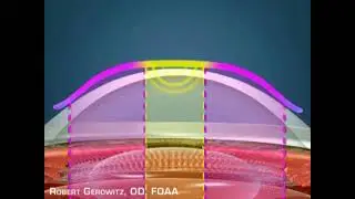 How Ortho-K Works on the Cornea &ndash; Corneal Reshaping Explained