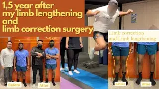 1,5 year after my limb lengthening and limb correction surgery | +6 cm more height