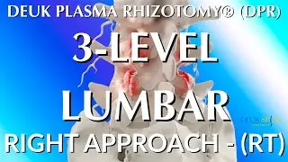 3-LEVEL LUMBAR - LIVE - Laser Spine Surgery