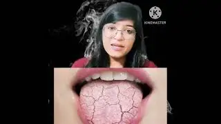 Deviated nasal septum|symptoms of deviated nasal septum #snoring #sleepapnoea #nasalblockage