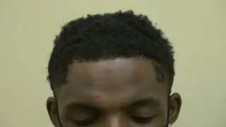 Hair Transplant on African American Curly Hair by Dr. John Diep