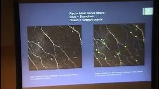 Corneal Nerves in Migraine Patients