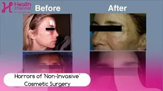 The horrors of 'non invasive' Plastic and Cosmetic Surgery.