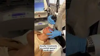 Fraxel to SMOOTH under eye WRINKLES #over40 #skincare #laser