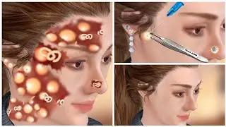 ASMR Ear acne removal | Pimple blackhead removal | Asmr Animation | 귀 여드름 | 여드름 블랙헤드 | 여드름 제거