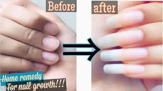 EASY home remedy for FASTER NAIL GROWTH!!!!!! My nail care routine |basic nail art tutorial