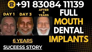 Best Dentist in Mumbai | Miracle Smile in Just 3 Days 🦷😁 | Full Mouth Implants - Dr Mayur Khairnar