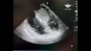 Mixoma atrial