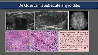Subacute lymphocytic thyroiditis Or silent thyroiditis, Clinical Presentation, Pathology, Symptoms