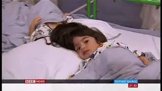Conjoined twins surgical separation of Safa and Marwa (UK/(Pakistan)) - BBC News - 15th July 2019
