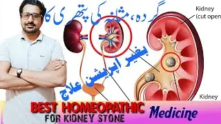 Stone Breaker Kidney Pain Best Homeopathic Medicine for Kidney Stone Berbres Vul, Hydrangea Q, BL-10