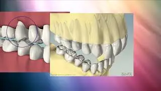 Communicating Occlusion
