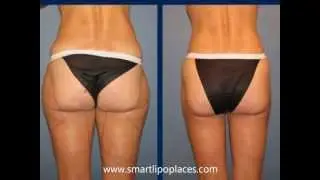 Amazing Vaser Lipo Reviews