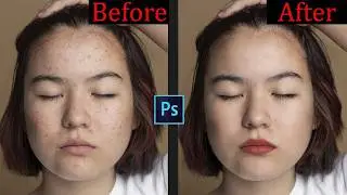 Removing acne, scars, or wrinkles