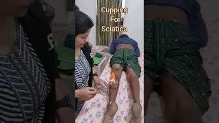 #cupping #sciatica   #firecupping for sciatica #cg  #shortsfeed #ytshorts