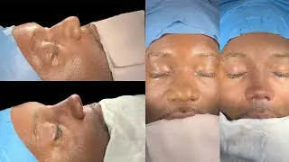 How to achieve natural and sharper look with closed ethnic rhinoplasty approach by DR Bora OK Turkey