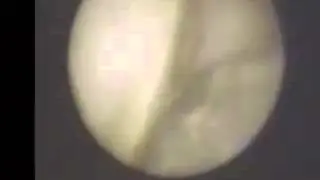 Hair-line Root Fracture viewed with the Perioscope