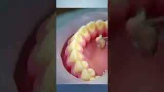 What Really Happens After You Lose a Tooth 😨 | Dental Implant Explained #facts #shorts #tooth loss