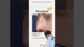 👃 Nose Job Before & After | #objetplasticsurgery #rhinoplasty #plasticsurgery #korea