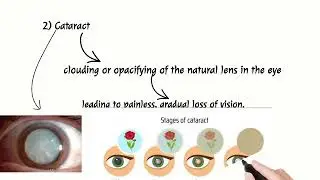 Common eye disease 